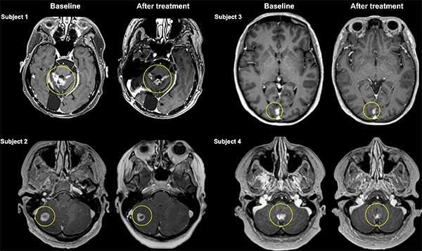 World-first clinical trial demonstrates focused ultrasound can deliver antibody therapy to breast cancer metastases in the brain