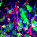 Nanoparticles in Brain Metastases