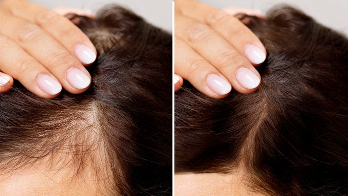 Close-up side by side before and after photos of hair loss and treatment.