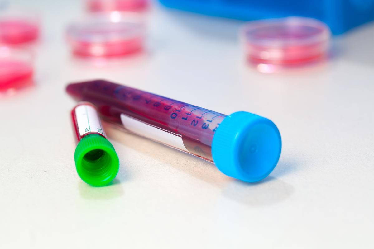 A new study proposes a blood biomarker could be a useful way to detect patients at risk of either developing diabetes or experiencing severe cancer outcomes