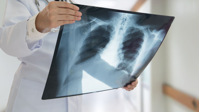 Pós-Covid: Maioria dos pulmões recupera bem, conclui estudo