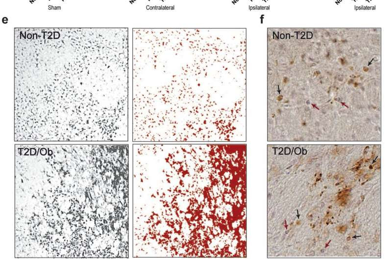 Weight loss may repair the brain after stroke in diabetes