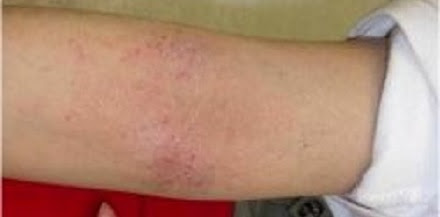 Allergic eczema on elbow