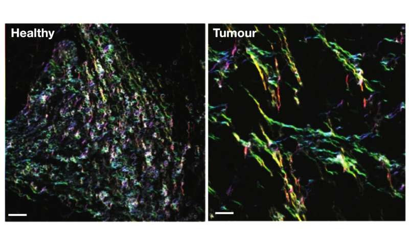 Collagen a key player in breast cancer metastasis