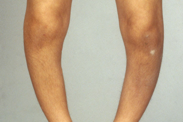 Protect Yourself Against Re-emergent Diseases You Thought Were Extinct — Leprosy, Plague, Gout, Scurvy, Rickets Protect Yourself Against Re-emergent Diseases You Thought Were Extinct — Leprosy, Plague, Gout, Scurvy, Rickets