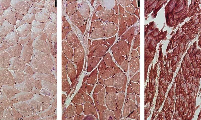 Researchers identify therapeutic targets to prevent cancer-associated muscle loss