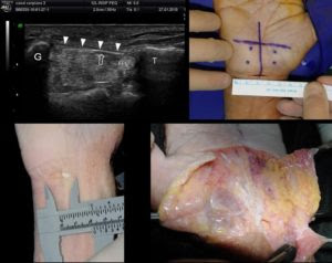 Imágenes de Operación Percutánea del Síndrome del Túnel Carpiano bajo Control Ecográfico, por parte del Dr. Javier De la Fuente traumatólogo de la unidad de ecografía musculoesquelética del centro médico Sendagrup de Donostia - San Sebastián