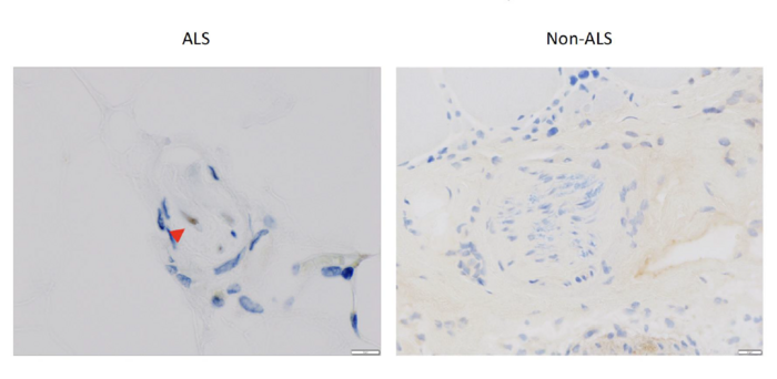 Accumulation of TDP-43 with ALS patients