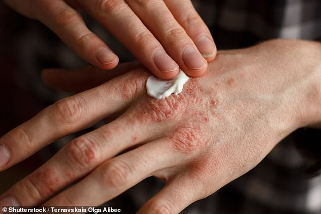 Scientists have developed an unlikely treatment for the dry skin condition eczema ¿ a cream that is packed with human skin bacteria