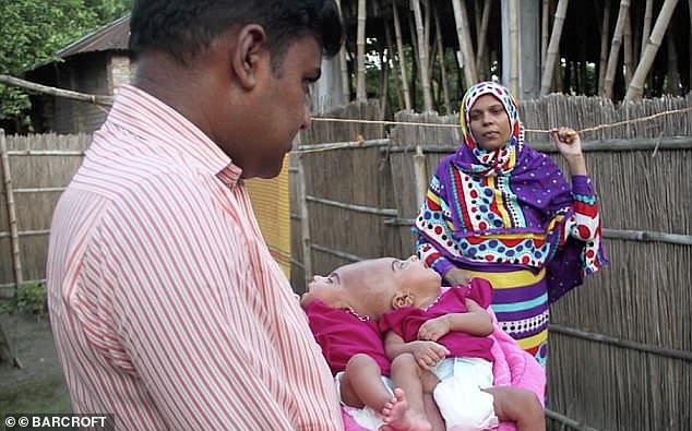 Rabeya and Rokeya have already amazed doctors as very few craniopagusconjoined twins survive birth
