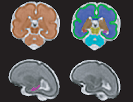 T2-Weighted Magnetic Resonance (MR) Imaging Brain Segmentation