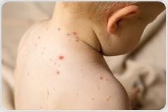 The return of the measles: are we going backward?