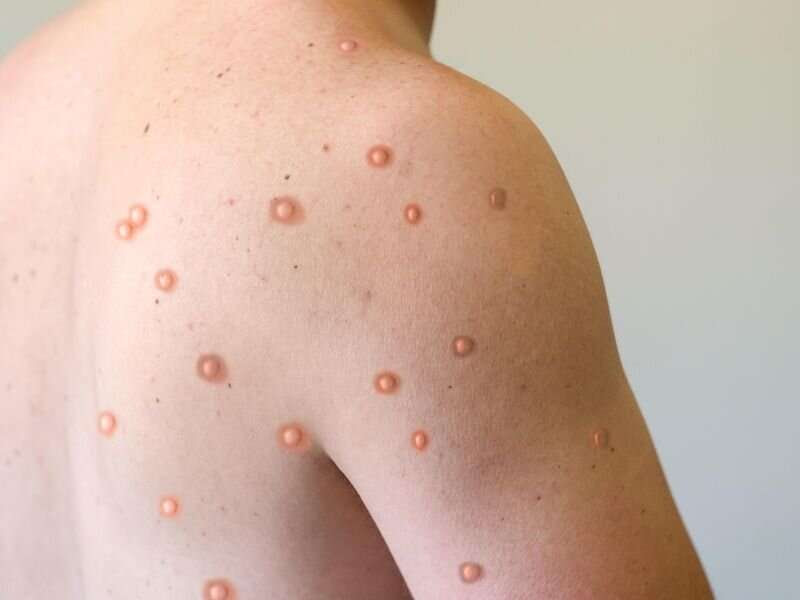 Fewer symptoms for mpox infection seen after vaccination